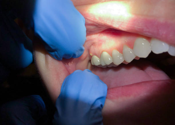 Best Broken or Cracked Tooth Emergency Dentist in Memphis, MO